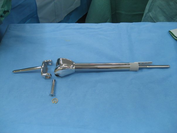 Titanium rod which replaced the removed bone