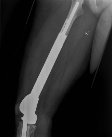 Sgan peledr-x o'r prosthesis titaniwm